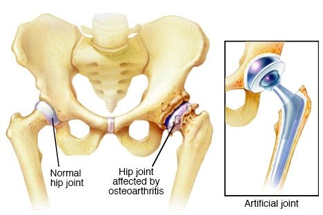 Hip Replacement Surgery