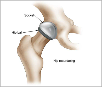 Hip Replacement