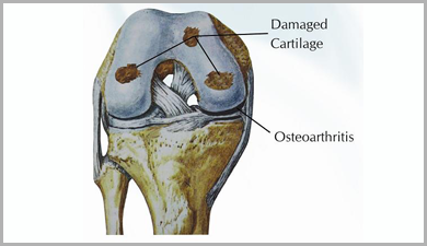 Osteoarthritis Knee