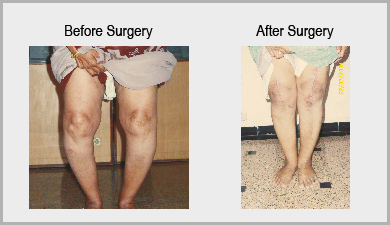 Osteoarthritis Knee Replacement Surgeon