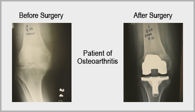 Osteoarthritis Knee Replacement Surgery