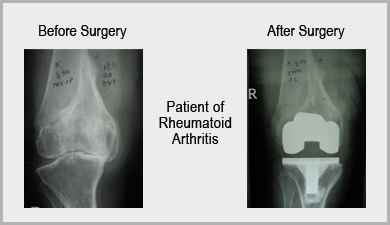 Rheumatoid Arthritis Knee