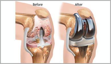 Knee Replacement Surgery in Ahmedabad